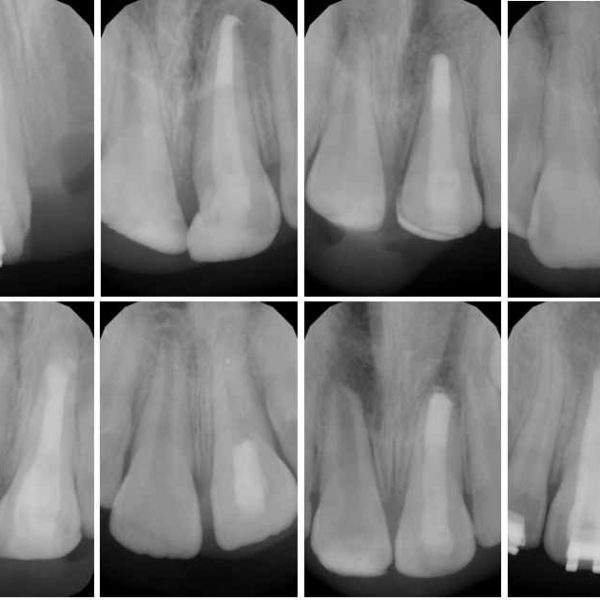 Endodontické ošetření zubu s nedokončeným vývojem